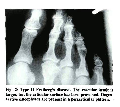 Problems Of The Second Metatarsophalangeal Joint