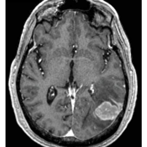 Contrast Enhanced Axial T1 Weighted Mri Reveals A Uniformly Enhancing Download Scientific