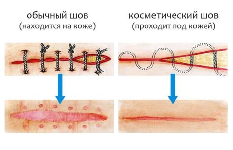 Как зашить рану: инструкция по наложению шва и дальнейший уход