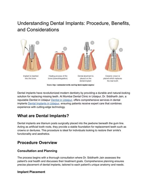 Ppt Understanding Dental Implants Procedure Benefits And