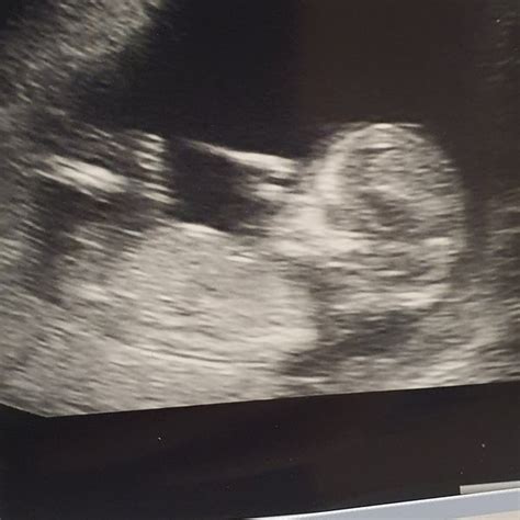 Any Sex Guesses From 12 Week Scan Mumsnet