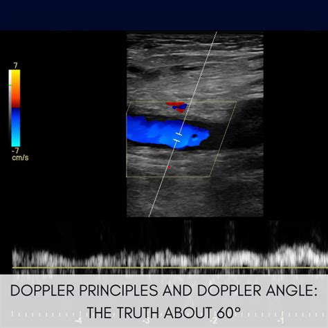 Doppler Principles And Doppler Angle The Truth About 60°