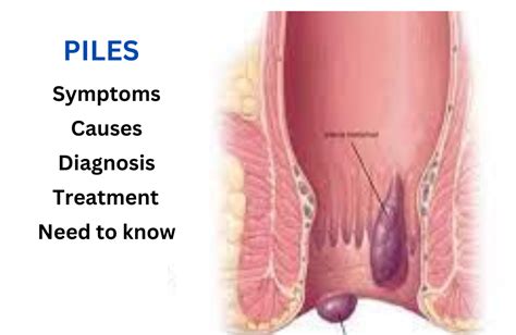 Piles: Understanding Symptoms, Causes, Treatment | MaxinHealth - Blog