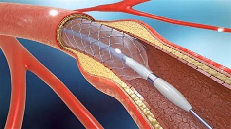 Angioplastia El Paso Tx Imaging Interventional Specialists