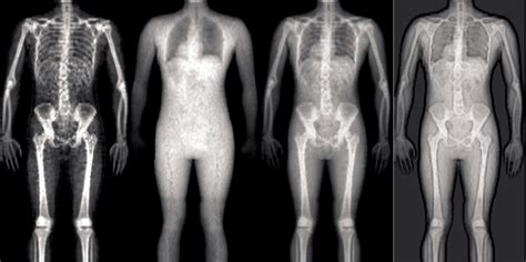 bone loss southwest floridas health  wellness magazine