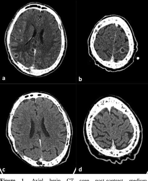 Figure 1 From Mediterranean Journal Of Hematology And Infectious