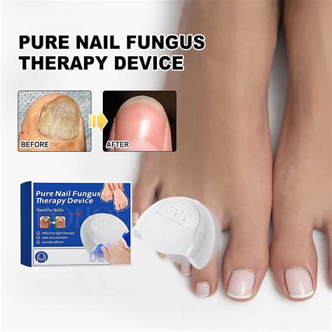 Fungus laser treatment device Onychomycosis laser effectively treats