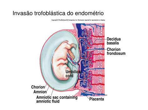 Doença Trofoblastica Gestacional - PPT - Doença Trofoblástica Gestacional PowerPoint Presentation, free ...
