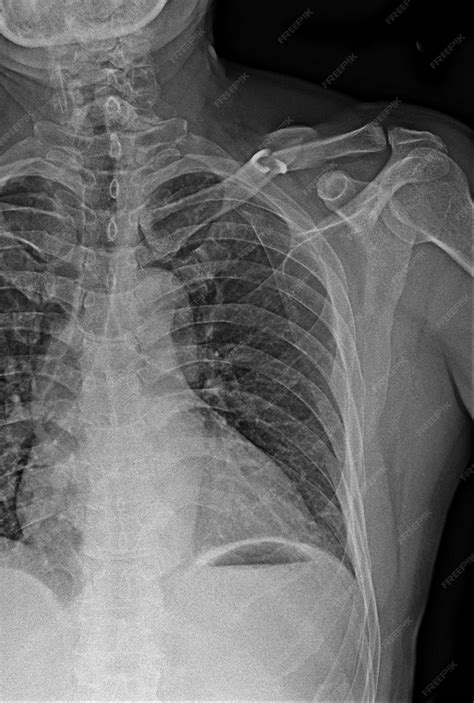 A chest radiograph shows a chest and a small hole in the left side of
