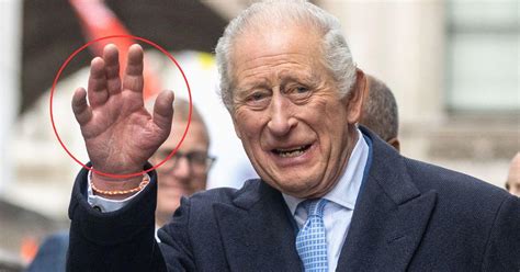 Exclusive Why Cancer Battling King Charles Fingers Are So Swollen