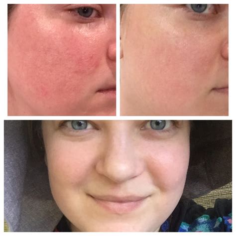 List 99 Pictures Retinol Peel Before And After Pictures Latest