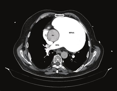 CT angiography shows a giant-size main pulmonary artery aneurysm ...