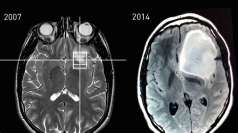 Astrocytoma: Types, Symptoms, Causes and Treatment | 2025