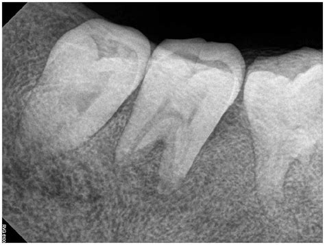 Fibrous Dysplasia Ground Glass