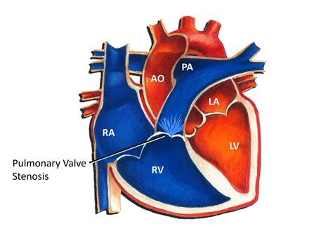 Pulmonary Valve Hypoplasia