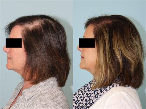 Hair Transplant Before And After 6 Jesse E Smith Md Facs Ft Worth