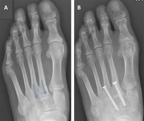 Midfoot Arthritis Foot Swelling The London Foot And Ankle Clinic