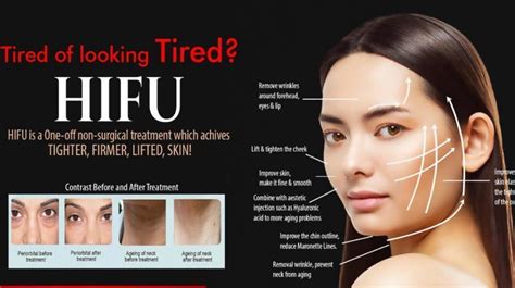 HIFU- Nonsurgical Face Lift