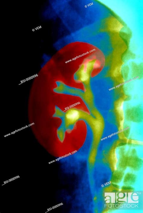 Kidney X Ray Stock Photo Picture And Rights Managed Image Pic Bsi