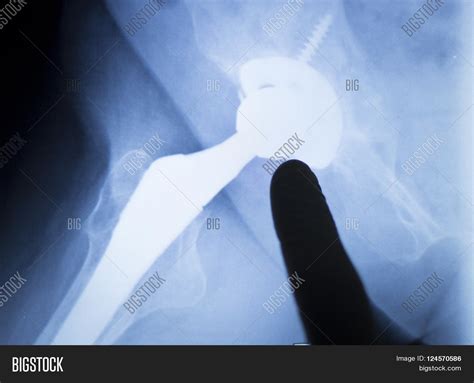 Hip Replacement Metal Image & Photo (Free Trial) | Bigstock