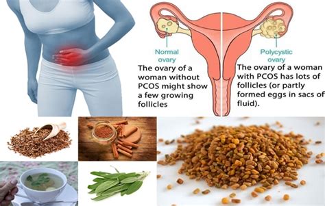 Cure Pcos Naturally