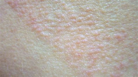 Polymorphous Light Eruption(PMLE) pictures and sun allergy rash images