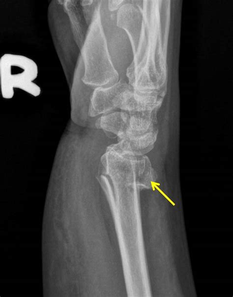 Colles Fracture X Ray