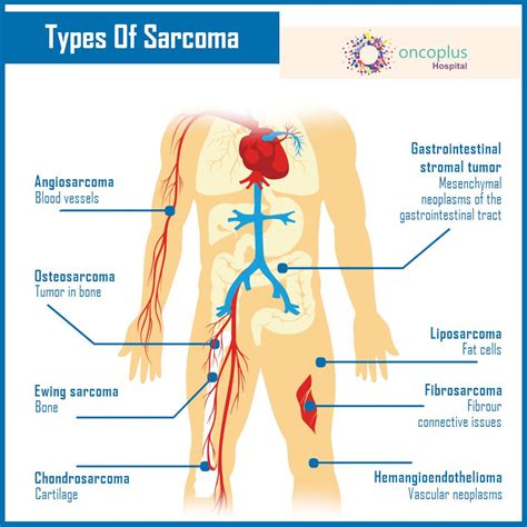 Guide To Sarcoma Cause Diagnosis And Symptoms