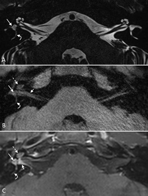 Mri Of The Internal Auditory Canal Labyrinth And Middle Ear How We