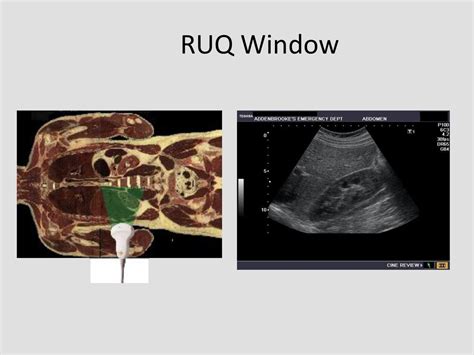 Abdominal Trauma Penetrating Trauma And Ultrasound Ppt Download