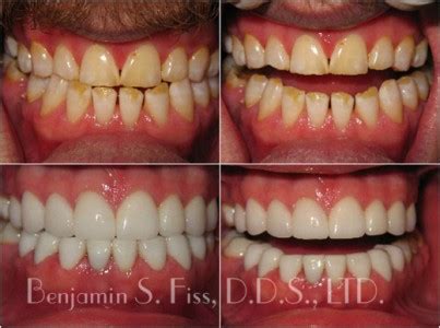 Porcelain Veneers In Chicago IL Chicago Benjamin S Fiss D D S