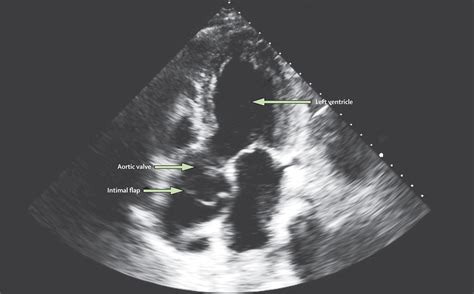 Delayed Presentation Of Acute Aortic Syndrome The Lancet