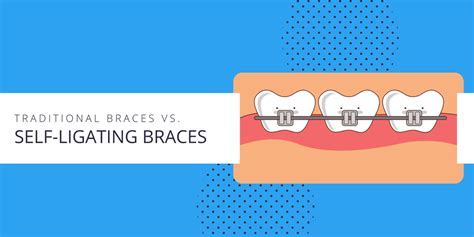 Self Ligating Braces Vs Traditional Braces