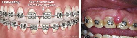 Unhealthy Gums With Braces