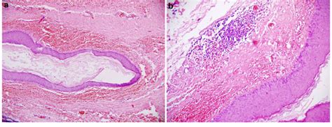 Photomicrograph Showing A Keratin Filled Cyst Lined By Stratified