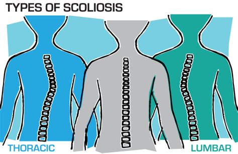 Scoliosis Winged Scapula Addressing The Impact Of Winged Scapula On Posture And Function In