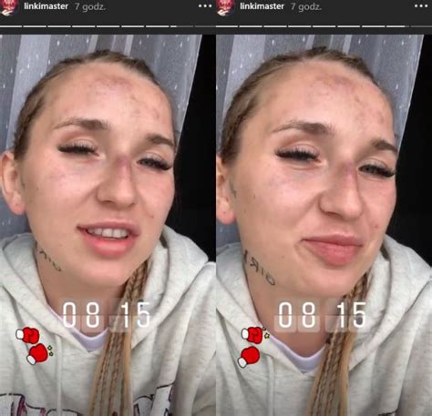 Dumna Marta Linkiewicz Pokaza A Twarz Po Walce Z Sex Masterk Nigdy Tak Zaje Cie Nie