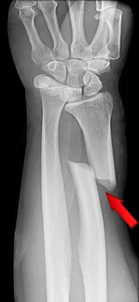 Fractura de cúbito y radio síntomas y tratamiento Camde