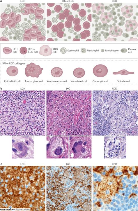 Nature Reviews Disease Primers On Twitter Histiocytic Disorders Are