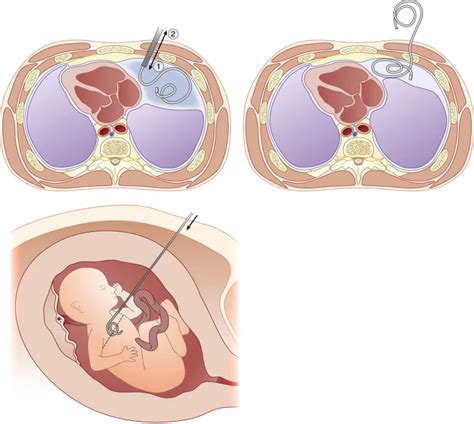 Drenos Fetali Medicina Fetal E Ultrassonografia