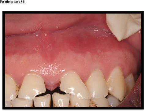 Hpv Warts On Gums