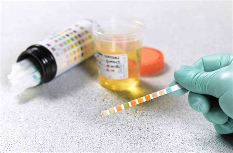Urine Glucose Test: What It Measures, Results, Next Steps