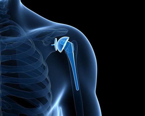 Shoulder Arthroplasty Joint Replacement Proliance Puget Sound