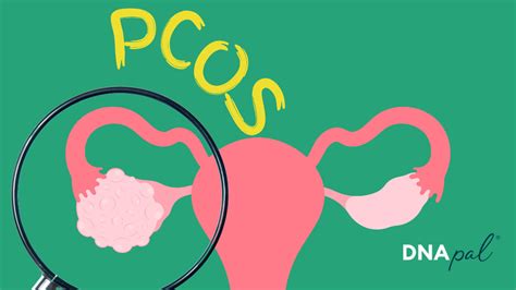 Polycystic Ovary Syndrome Understanding And Managing Pcos