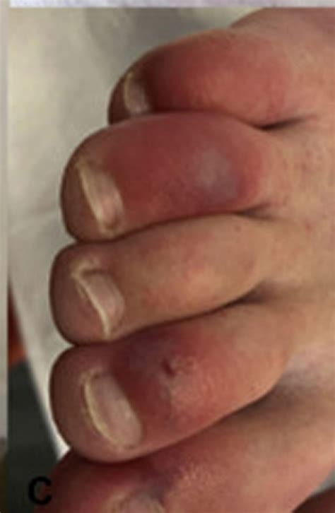 Covid toes: People with coronavirus may develop skin condition lasting
