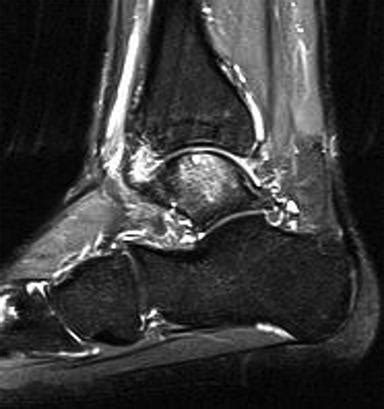 Orthobiologics in Foot and Ankle Applications - Clinical Tree