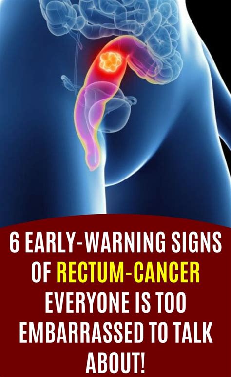 6 Early Warning Signs Of Rectum Cancer Everyone Is Too Embarrassed To