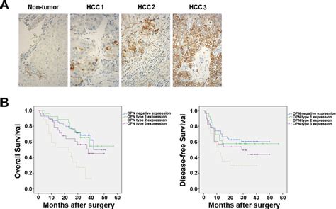 Opn Expression Is Heterogeneous Across Hcc Tumors A Representative