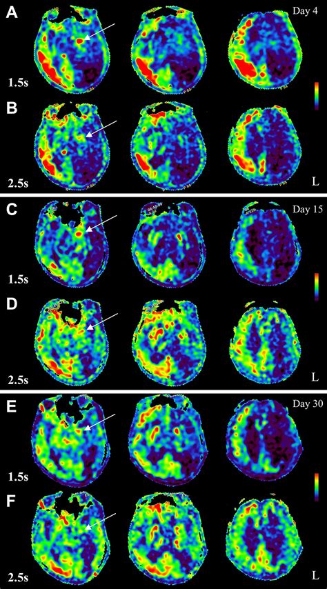 arterial spin labeling