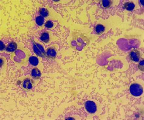 Intracellular Monosodium Urate Crystal Azureosine Staining Thus Msu